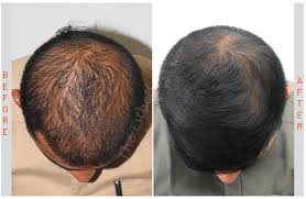 Biotin Therapy